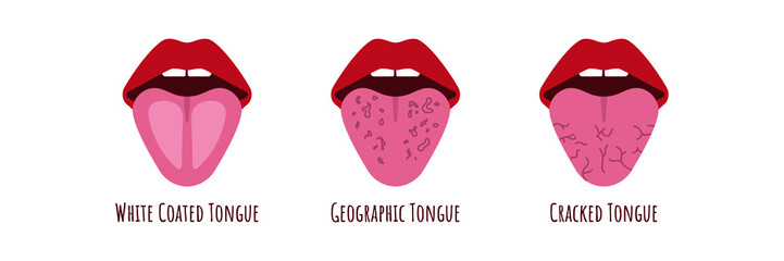 Tongue problems. White coated Cranched, Geograohic tongue. Oral thrush. Candidiasis on the tongue. Fungus in the mouth. Vector - obrazy, fototapety, plakaty