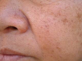 Freckles on the face. closeup photo, blurred.