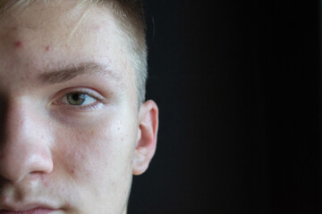 14 year old guy with problem skin