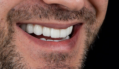 press ceramic crowns on implant bridges