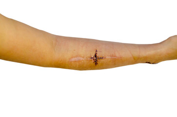 stitches after surgery isolated background