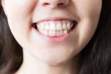 Dentistry. Demonstration of woman's beautiful smile. The concept of teeth whitening and alignment