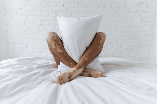 Woman With Vitiligo Holding Pillow Between Legs On Bed In Front Of White Wall