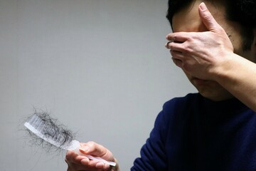髪の抜け毛に悩む日本人男性
