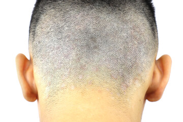Seborrheic dermatitis. Appears as white, itchy, and scaly dandruff on the head
