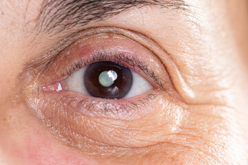 Female eye showing cataract, which can lead to partial loss of vision or blindness