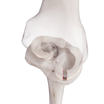 3d rendered medically accurate illustration of a torn medial miniscus