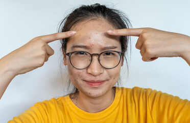 Portrait of unhappy Asian woman pointing to acne inflamed on her forehead. Conceptual shot of Acne...