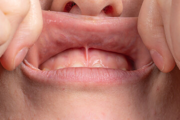 Macro of upper lip frenulum of a mouth of a woman