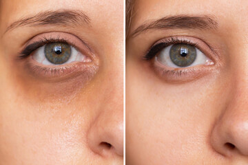 Cropped shot of a young caucasian woman's face with dark circles under eyes before and after cosmetic treatment. Bruises under the eyes caused by fatigue, insomnia, stress. The result of therapy