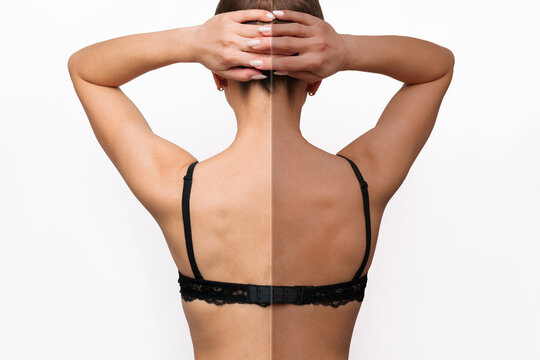 Portrait Of A Young Caucasian Woman Standing With Her Back Before And After Tanning Isolated On A White Background. The Result Of Self-tanning. Tanned Skin, Contrast Of Skin Colors