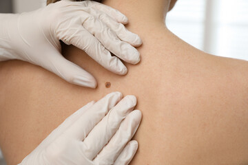 Dermatologist examining patient's birthmark in clinic, closeup view