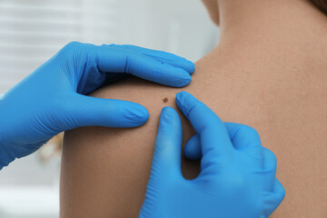 Dermatologist examining patient's birthmark in clinic, closeup view