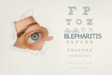 Blepharitis disease poster with eye test and blue eye on left. Studio grey background