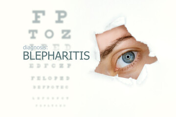 Blepharitis disease poster with eye test and blue eye on right. Isolated on white