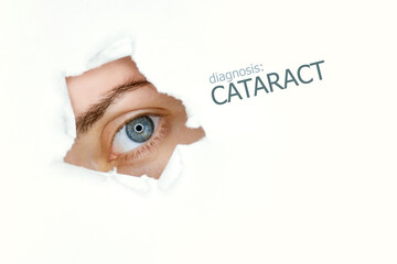 Cataract disease poster with  blue eye on left.Isolated on white