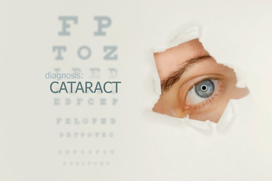 Cataract disease poster wwith eye test chart and blue eye on right. Studio grey background