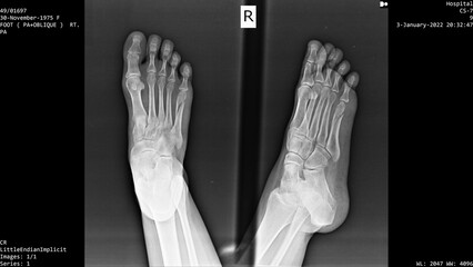Bone X-ray image of a woman's right foot. It was found that the bone in the right foot was broken due to falling down the stairs. It is an X-ray image no later than 1 hour after the accident. © Krich