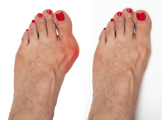 A closeup view on the bare foot of an elderly woman suffering from hallux valgus before and after surgery