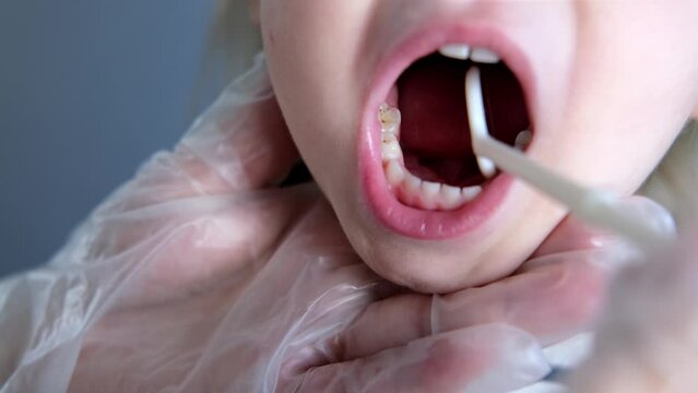 dentist, doctor examines oral cavity of small patient, uses mouth mirror, closeup baby teeth child, concept pediatric dentistry, dental treatment, correction of occlusion, oral care, caries prevention