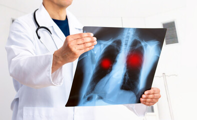 Lung Cancer or Pneumonia. Doctor check up x-ray image have problem lung tumor of patient or long...