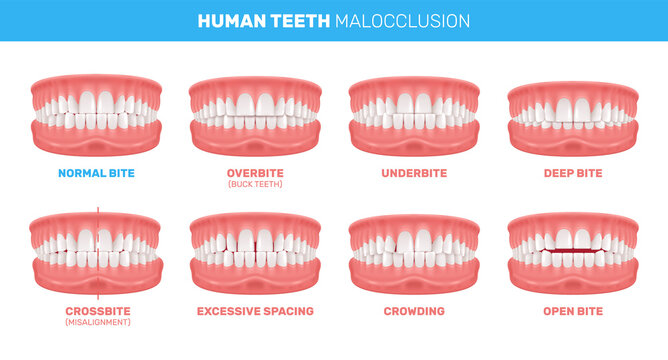 Malocclusion Of Teeth Infographics