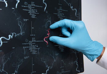 Doctors reviewing brain x-rays;MRI of the blood vessels in the brain and cerebrovascular disease or...
