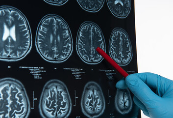 Doctors reviewing brain x-rays;MRI of the blood vessels in the brain and cerebrovascular disease or...