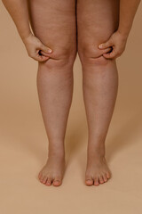 Cropped vertical photo woman bare naked legs, pinching fat on knees. Clipping fat folds. Removal of...