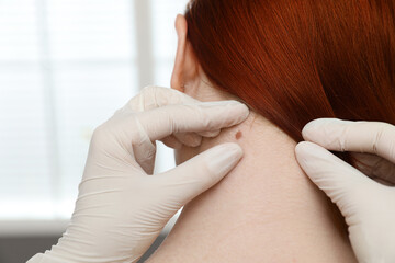 Dermatologist examining patient's birthmark in clinic, closeup view