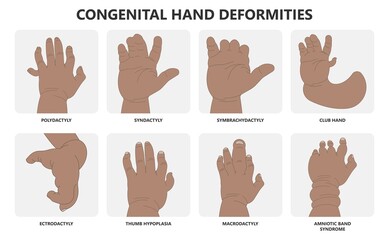 Obraz premium Hand finger gene prader willi band autism surgery baby simple thumb Apert minor born toes feet fused club hand Cleft Birth Ulnar multiple leg clubfoot child claw aplasia wrist forearm deformity extra