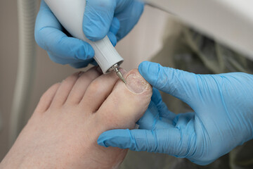 Pedicure podology treatment process of onychomycosis fungal infection of the toenail. filing of the...