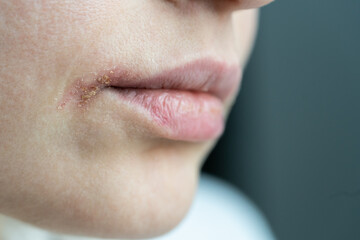 Closeup of female dry lips affected by herpes, suffering from food allergy, infection or virus. Sore woman lips with herpes disease, irritated skin. Beauty dermatology concept. 