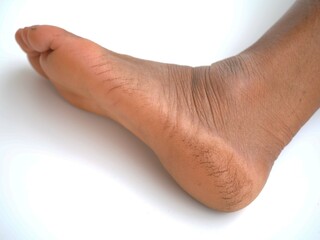 Cracks on heels of human. closeup photo, blurred.