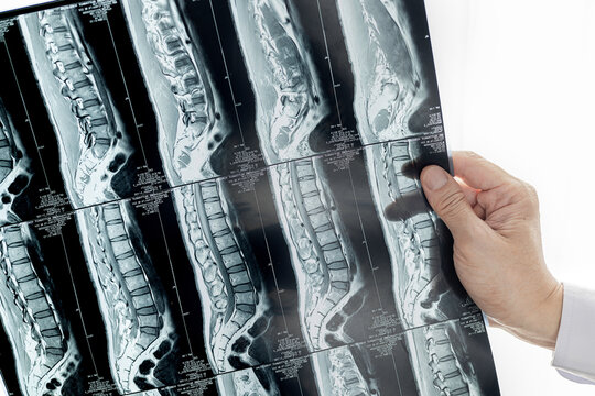 A doctor looking at MRI image of spines.