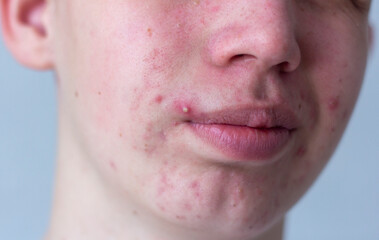 A picture of acne on the face of a teenager . Pimples, red scars and black dots on cheeks and chin....