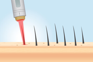 Laser hair removal at the skin layer and follicle for beauty and smoothness. Illustration about epilation on the body with IPL.
