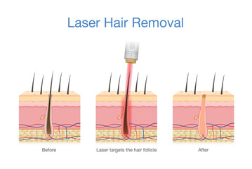 Laser hair removal at the skin layer and follicle for beauty and smoothness. Medical diagram before and after use laser get rid hair.