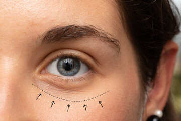 girl eye with lines and arrows indicating the correction of aesthetic marks for bags under the eyes