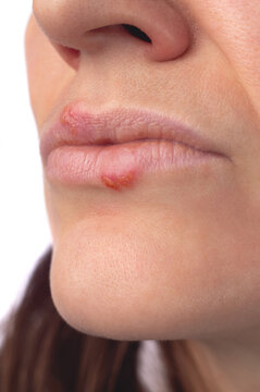 Herpes virus. Herpes disease on the lips of a 30 year old woman. Infectious virus. Close-up of the manifestation of herpes on the lips.