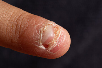 Finger nail with onychomycosis and blank background