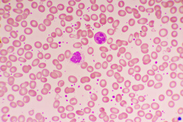 Essential thrombocytosis blood smear, present abnormal high platelet and neutrophil cell, analyze...
