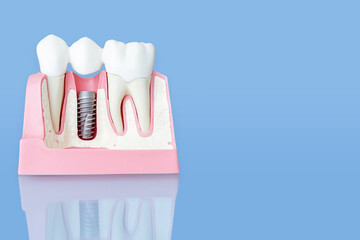 Close up of a Dental implant model. Blue background.
