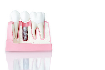 Close up of a Dental implant model. White background.