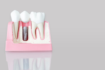 Close up of a Dental implant model. Grey background.