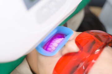 A woman wearing protective glasses  examining by stomatologist , Tooth whitening by ultraviolet lamp