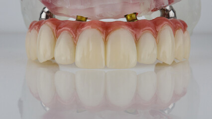 temporary dental prosthesis of the upper jaw with an artificial gum on a model with a white background