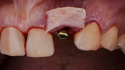 soft tissue flap on the gum for tissue grafting