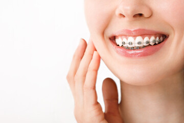 Smile with Braces Orthodontic Treatment. Dental Care Concept. Beautiful Woman Healthy Smile close...