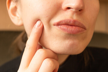 Young woman points her finger at her lips infected herpes virus. Indignation look. Diseases of the immune system.